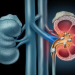 Illustration of kidneys with a kidney stone