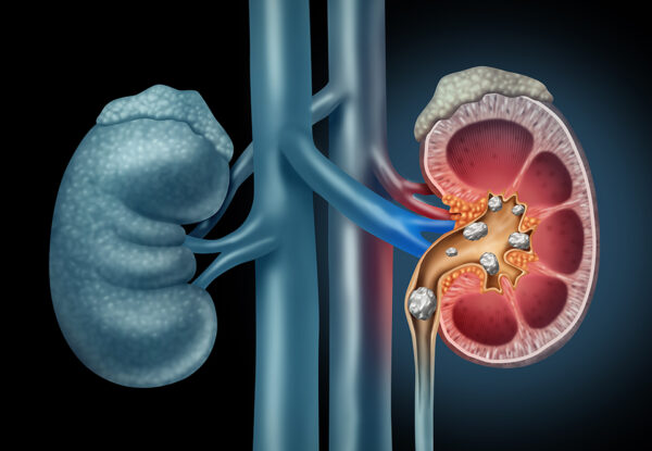 Illustration of kidneys with a kidney stone