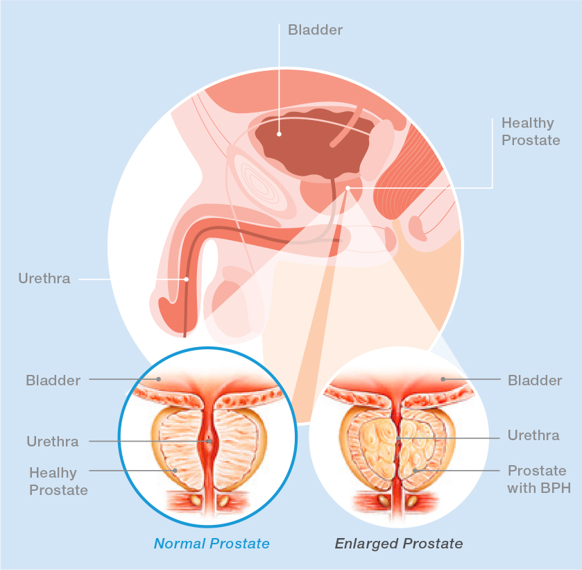 Anatomy of the male reproductive system showing enlarged prostate gland.