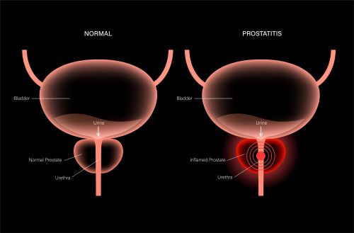 Diagram showing inflamed prostate with red rings